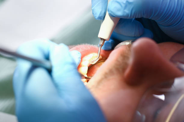 Best Knocked-Out Tooth (Avulsed Tooth) Treatment in Westlake Village, CA